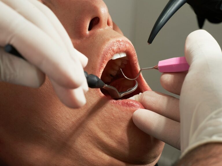 Finding an English speaking dentist in Curaçao: Close-up of dental exam with mirror and probe, highlighting oral health check-up.