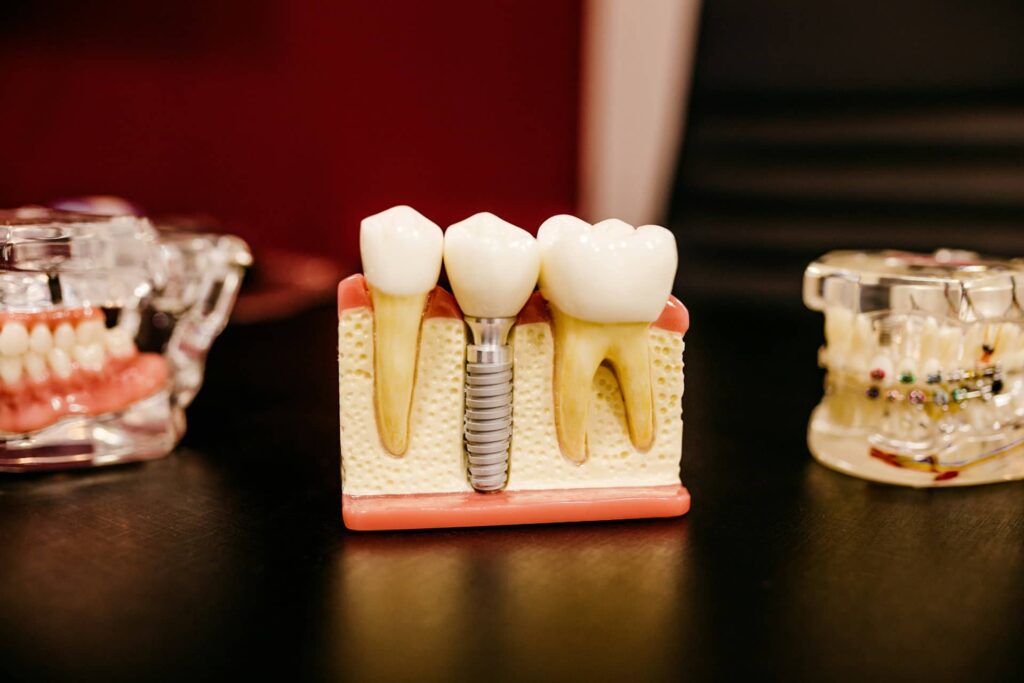 Dental implants model showing titanium screw, crown, and surrounding natural teeth.